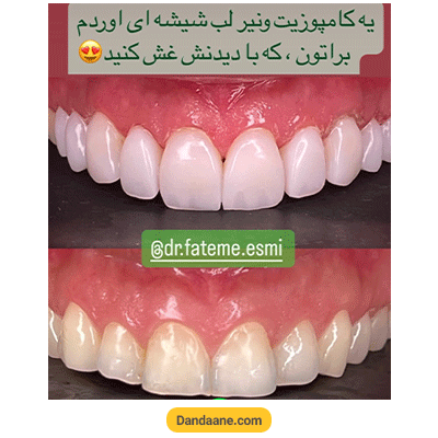 نمونه کار کامپوزیت دندان دکتر فاطمی اسمی  شماره 5