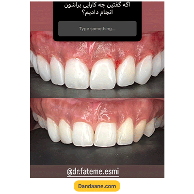 نمونه کار کامپوزیت دندان دکتر فاطمی اسمی