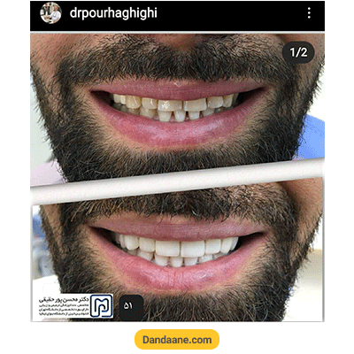 نمونه کار کامپوزیت دندان دکتر محسن پور حقیقی شماره 1