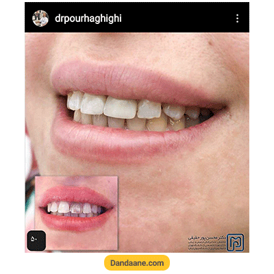 نمونه کار کامپوزیت دندان دکتر محسن پور حقیقی - شماره 2