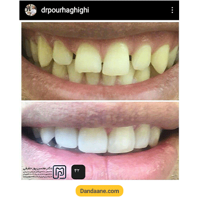 نمونه کار کامپوزیت دندان دکتر محسن پور حقیقی - شماره 3