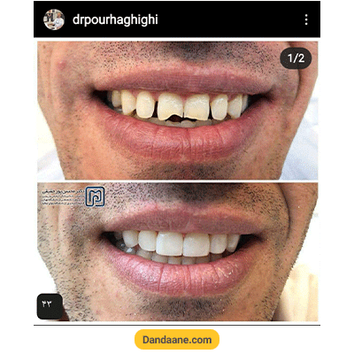 نمونه کار کامپوزیت دندان دکتر محسن پور حقیقی شماره 4