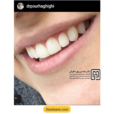 نمونه کار بعد کامپوزیت دندان دکتر محسن پور حقیقی