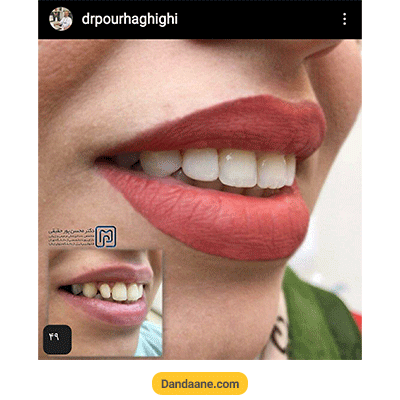 نمونه کار کامپوزیت دندان دکتر محسن پور حقیقی