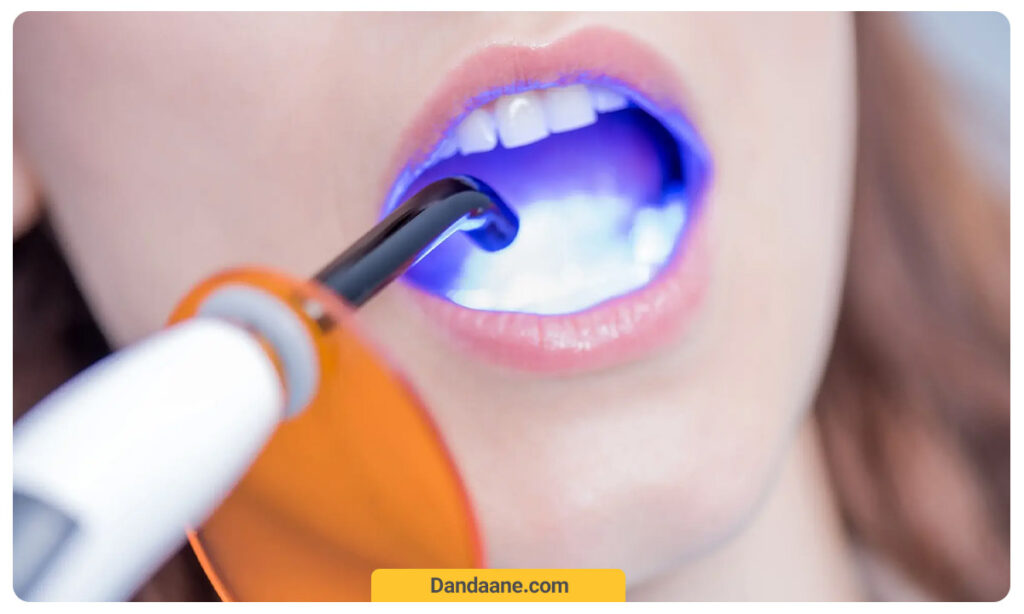 نور درمانی لمینت دندان