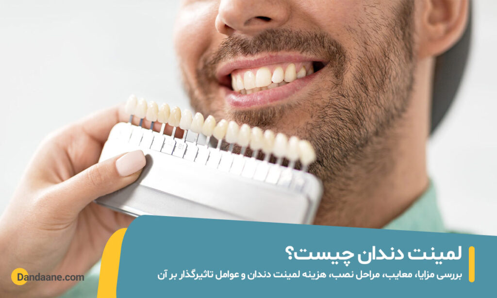 لمینت دندان