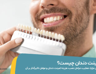 لمینت دندان