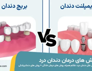 بریج یا ایمپلنت دندان