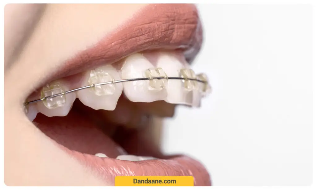 ارتودنسی دیمون شفاف