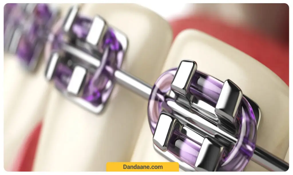 تصویر شماتیک از ارتودنسی دیمون 