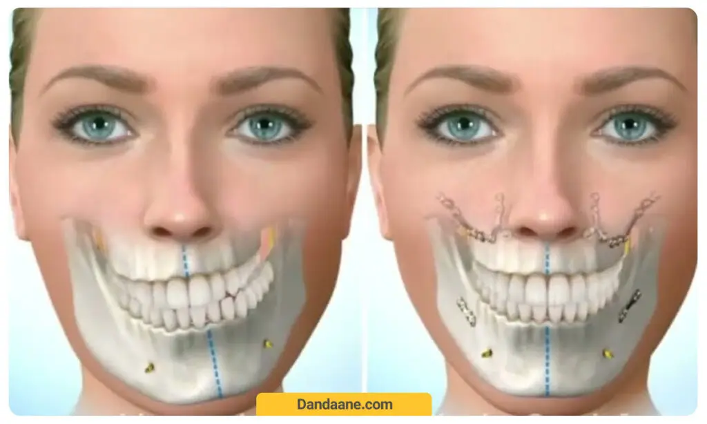 تصویر قبل و بعد از جراحی فک و صورت 