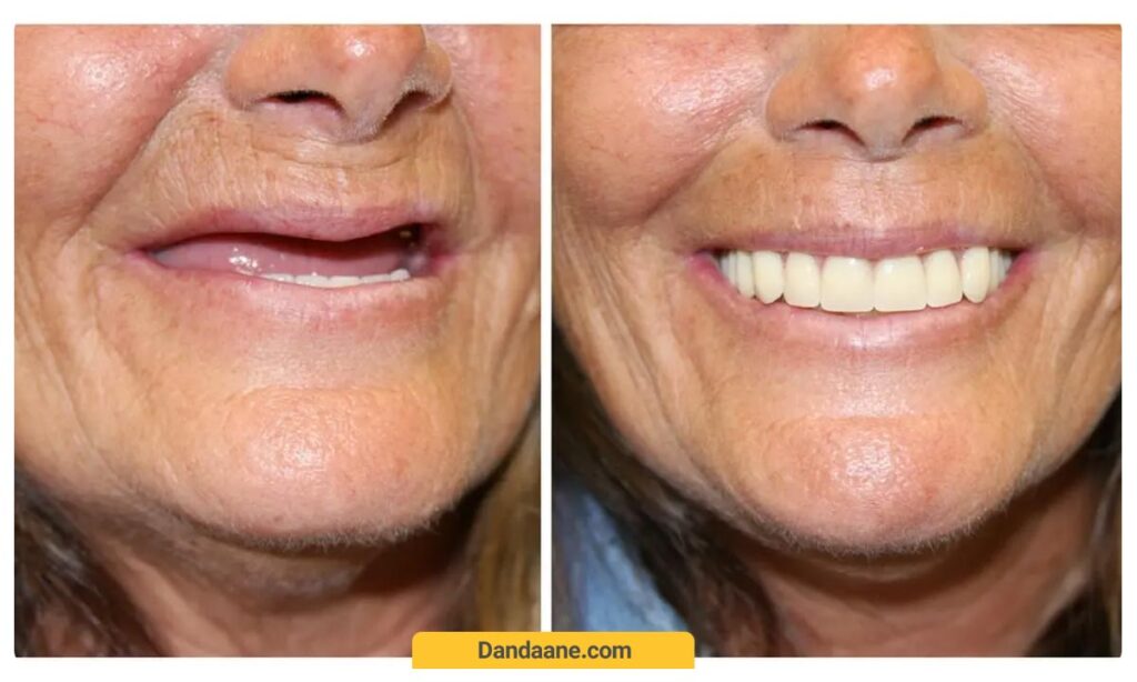 تصویر قبل و بعد از انجام پروتزهای دندانی 