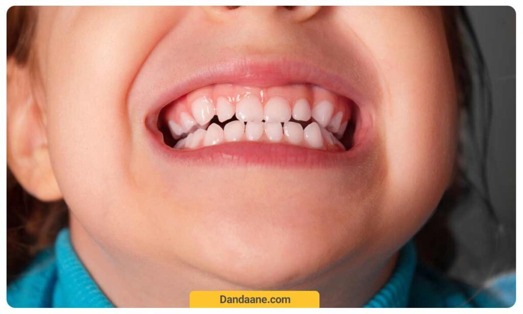 دندان قروچه در کودکان