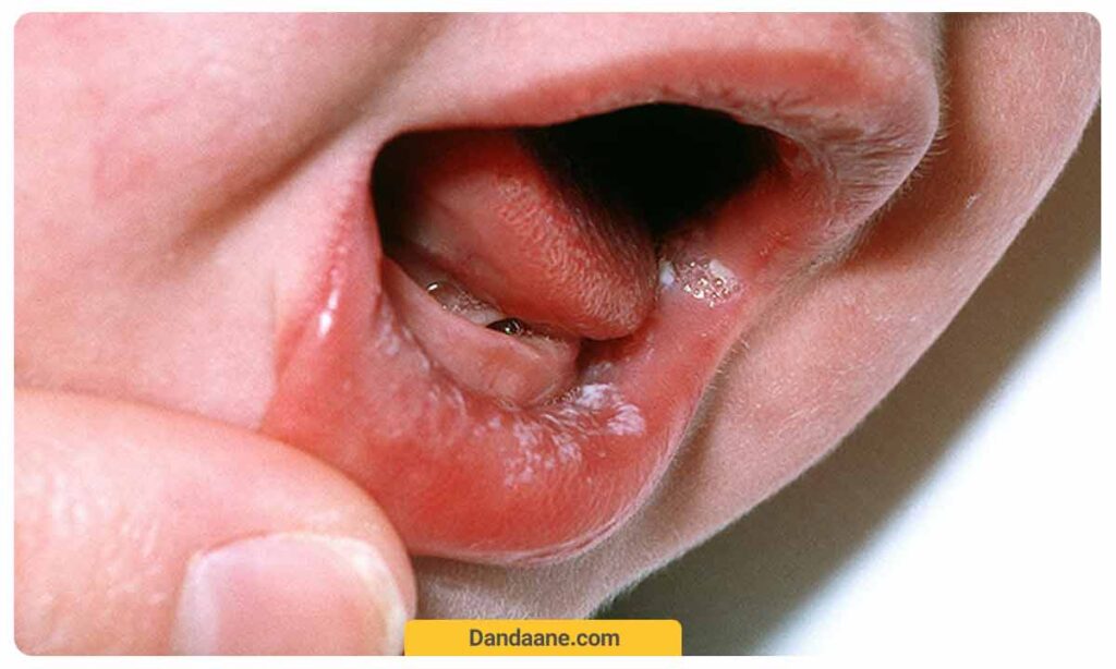 سیستم ایمنی نابالغ یکی از دلایل ایجاد برفک دهان در کودکان است