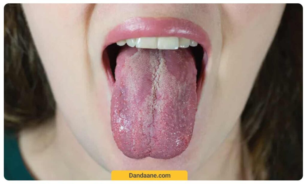 از علائم برفک دهان می توان به درد  و سوزش دهان و مشکل در بلعیدن غذا اشاره کرد.