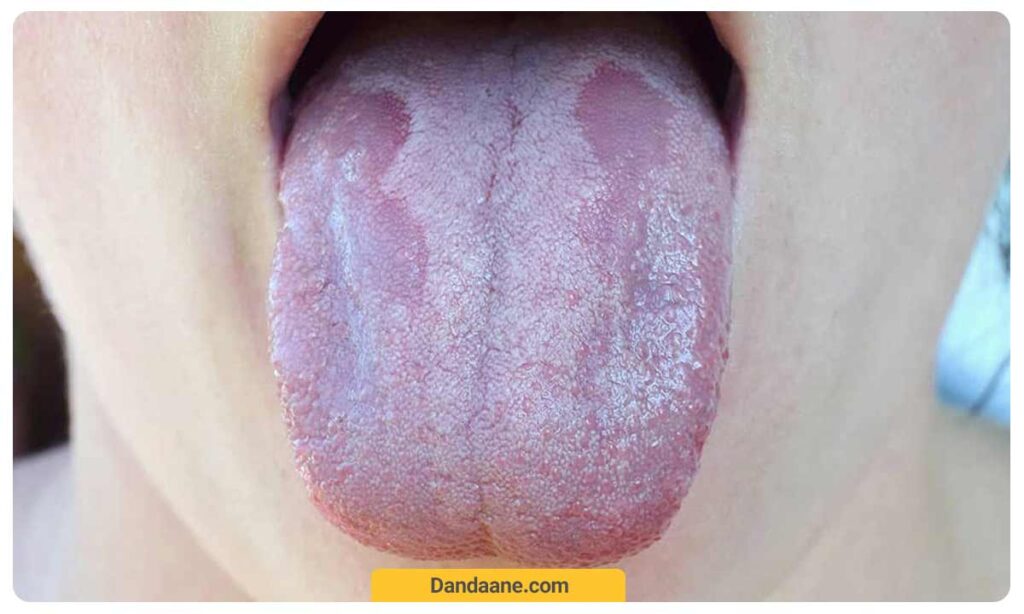 داشتن عفونت مخمری در سینه مادر از دلایل برفک دهان نوزاد است