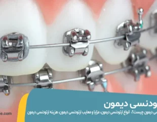 ارتودنسی دیمون