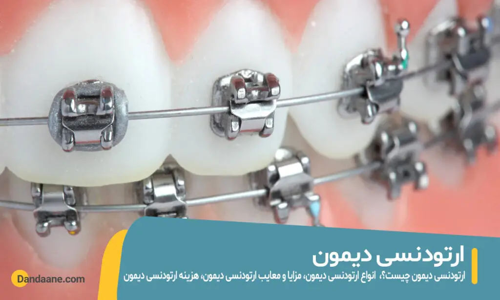 ارتودنسی دیمون