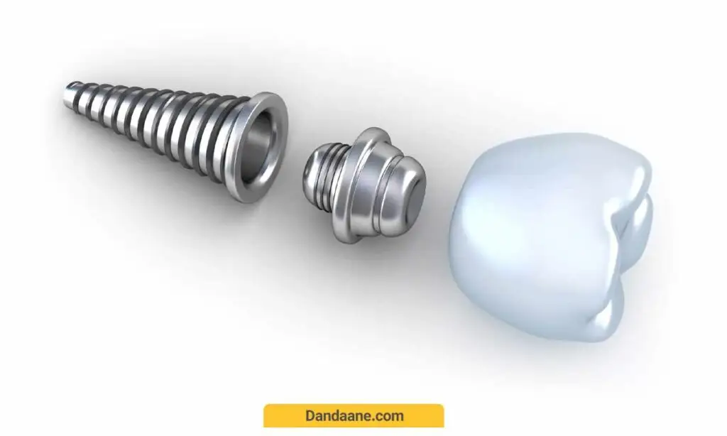 طول عمر ایمپلنت سوئیسی، آمریکایی، آلمانی، کره ای و ایرانی