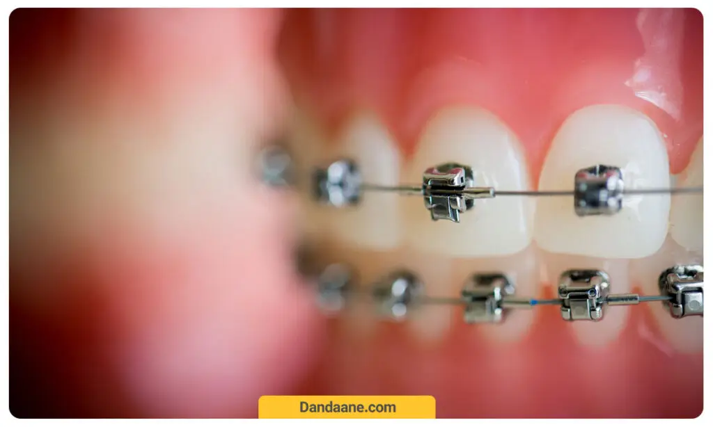 تصویر شماتیک از ارتودنسی دندان 