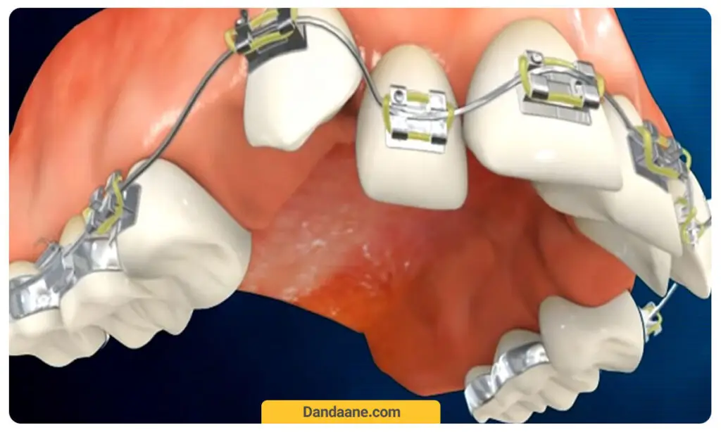  پر شدن جای دندان کشیده شده در ارتودنسی