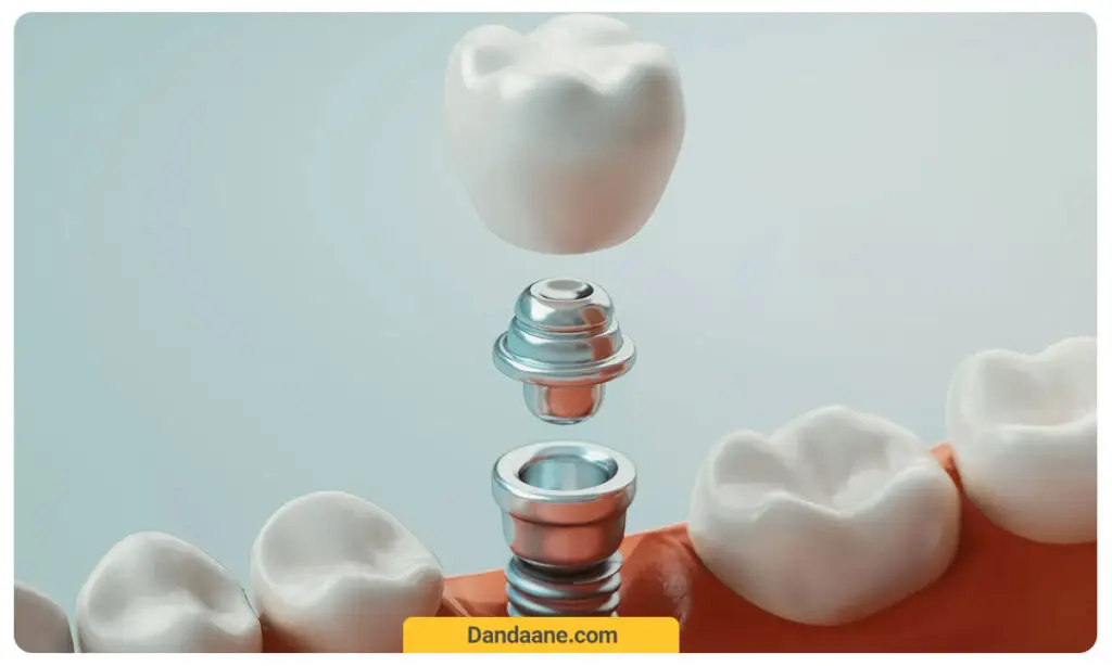 طول عمر دندان های ایمپلنت شده