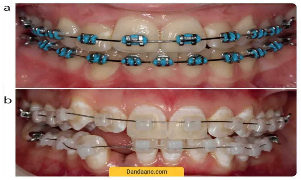 تصویر کشیدن دندان در ارتودنسی 
