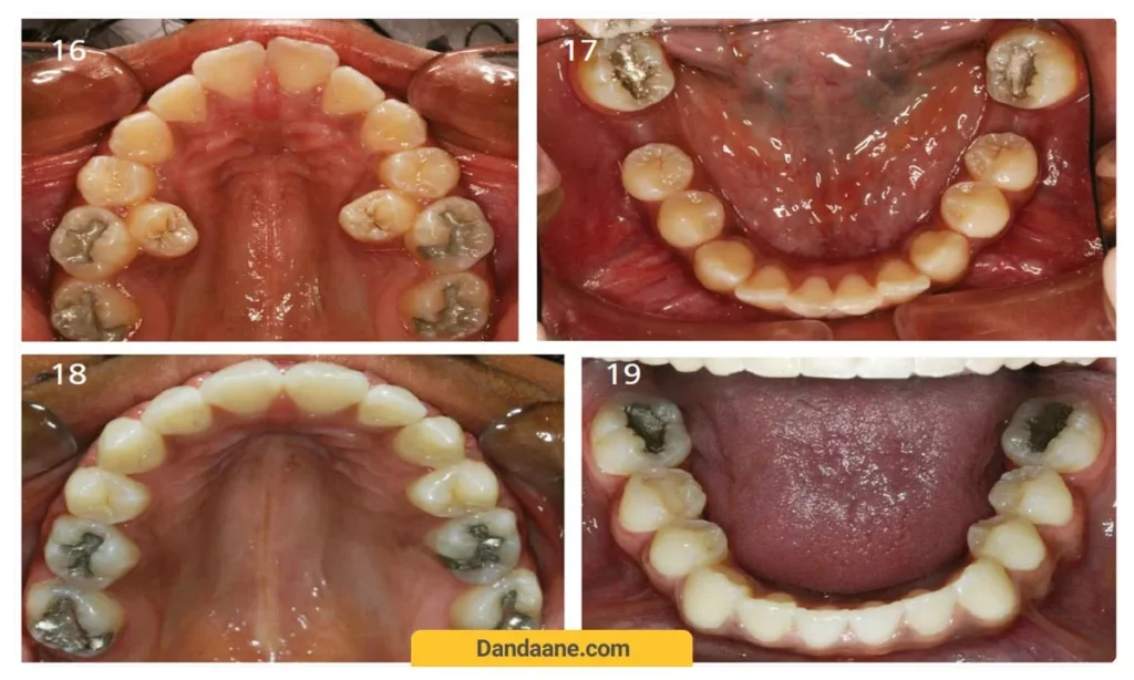 تصویر قبل و بعد از کشیدن دندان در ارتودنسی 
