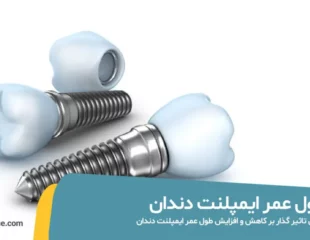 طول عمر ایمپلنت دندان