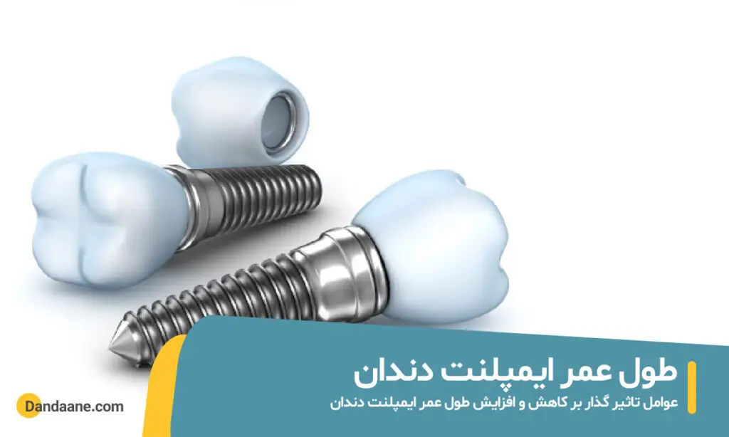 طول عمر ایمپلنت دندان
