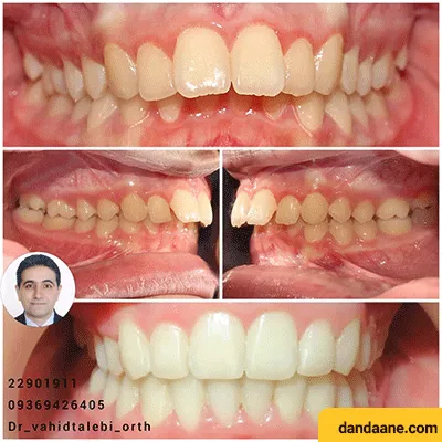 قبل و بعد درمان عقب رفتگی فک پایین و بیرون زدگی فک بالا توسط دکتر وحید طالبی