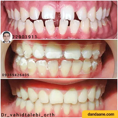 قبل و بعد نمونه کار ارتودنسی دکتر وحید طالبی