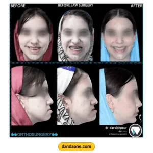 نمونه کار ارتودنسی با جراحی فک دکتر هادی درویش پور
