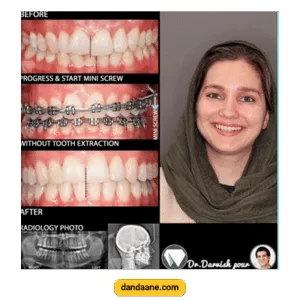 نمونه کار ارتودنسی دکتر هادی درویش پور