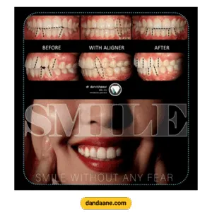 نمونه کار ارتودنسی نامرئی دکتر هادی درویش پور