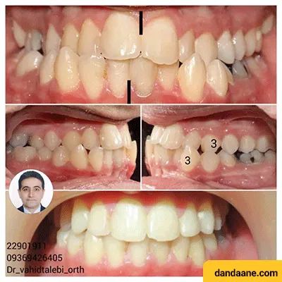 نمونه کار درمان تنگی فک بالا و بیرون زدگی فک پایین توسط دکتر وحید طالبی