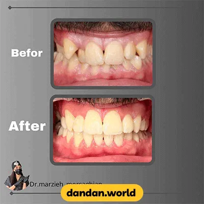 نمونه کار قبل و بعد درمان ارتودنسی دکتر مرضیه مرساقیان شماره 2