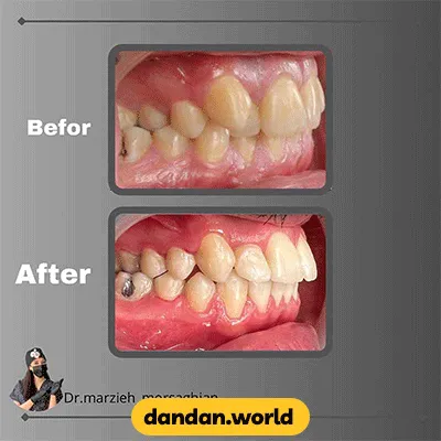 نمونه کار قبل و بعد درمان ارتودنسی دکتر مرضیه مرساقیان
