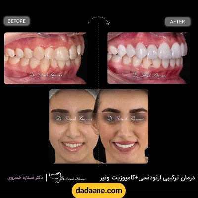 نمونه کار قبل و بعد ارتودنسی دندان دکتر ستاره خسروی