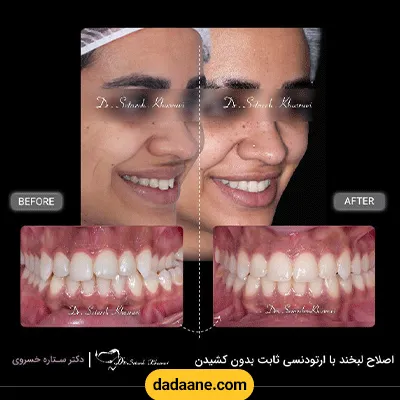 نمونه کار قبل و بعد ارتودنسی دندان دکتر ستاره خسروی شماره 1