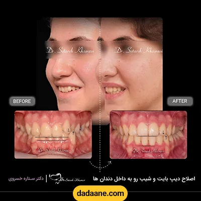 نمونه کار قبل و بعد ارتودنسی دندان دکتر ستاره خسروی شماره 2