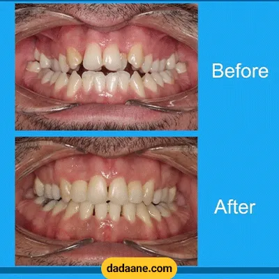 قبل و بعد نمونه کار ارتودنسی دکتر شاهرخ یگانه شماره 1