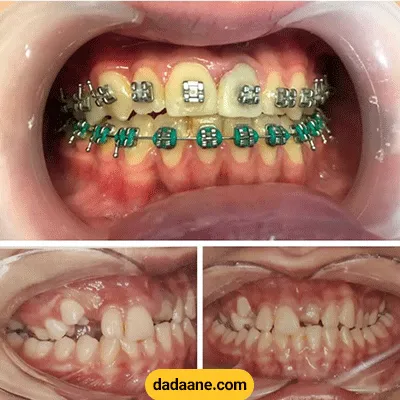 قبل و بعد نمونه کار ارتودنسی دکتر شاهرخ یگانه شماره 2