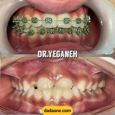 قبل و بعد نمونه کار ارتودنسی دکتر شاهرخ یگانه
