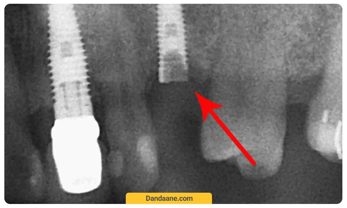 عکس ایمپلنت دندان ارزان و شکست خورده