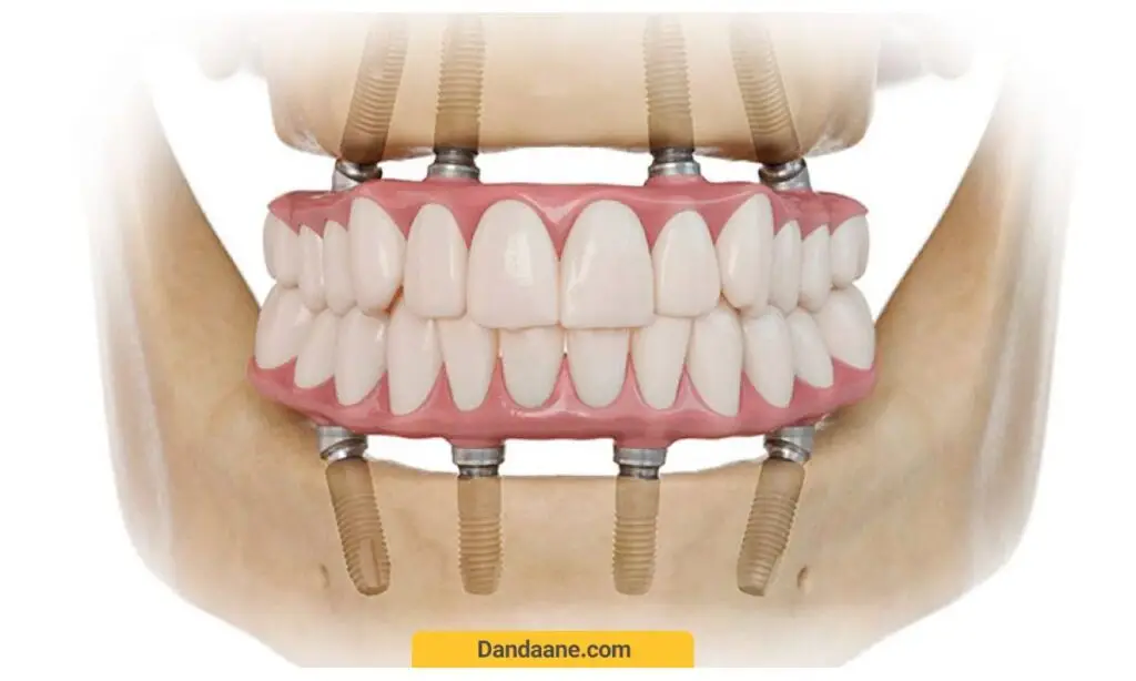 عکس ایمپلنت کامل دندان