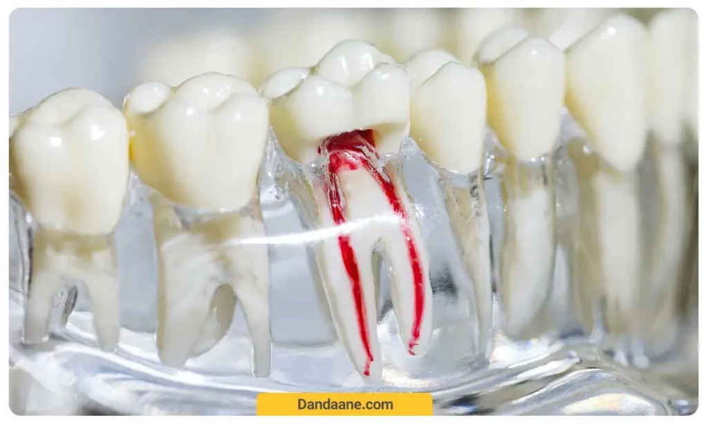 تصویر نمادین از عصب های دندان که با رنگ قرمز مشخص شده