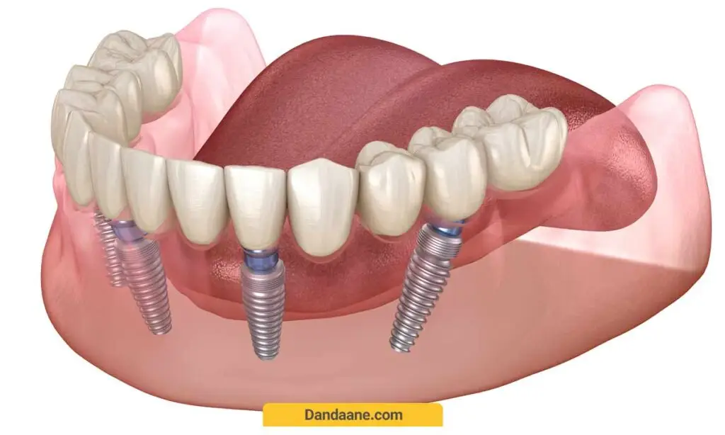 تصویر شماتیک ایمپلنت کامل فک پایین