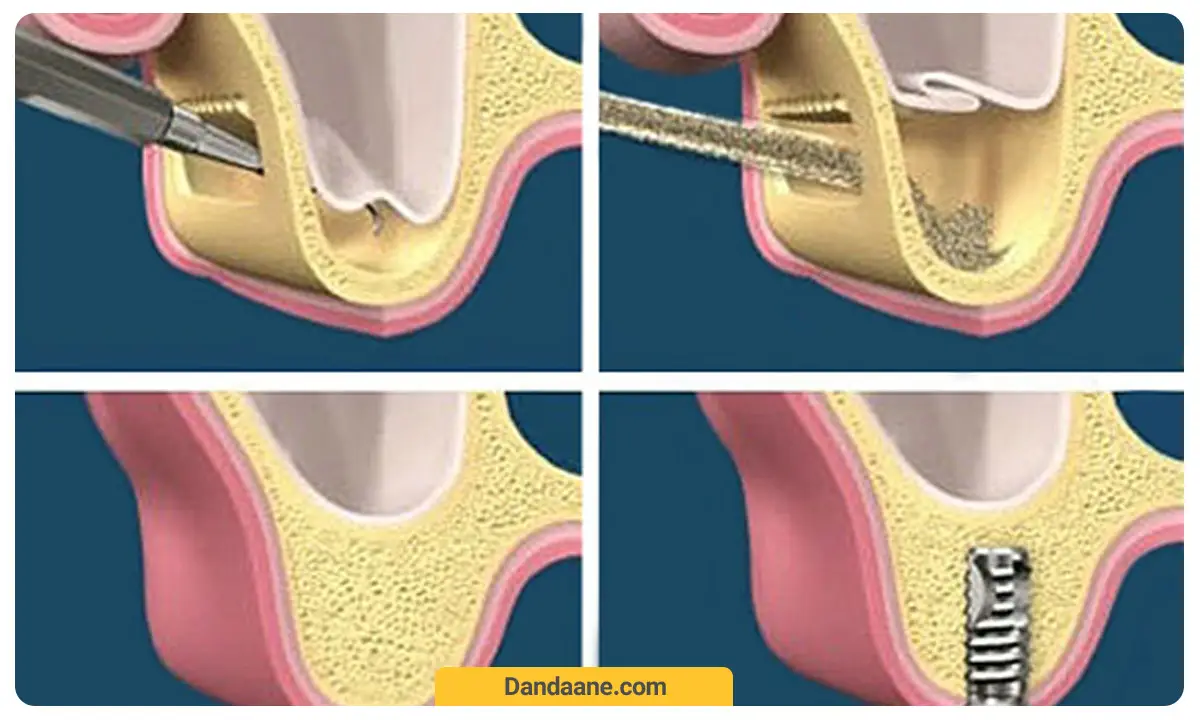 عکس شماتیک عمل سینوس لیفت