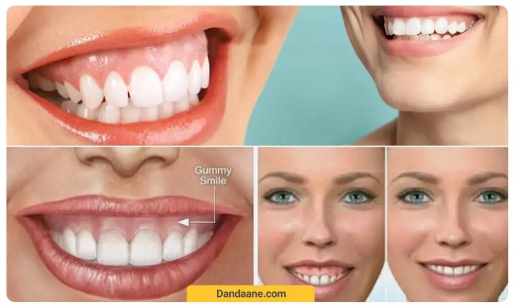 لبخند لثه ای